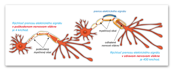Skleróza multiplex môže spôsobovať veľké množstvo neurologických symptómov.